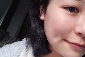 安醫(yī)二附院整形外科下頜角怎么樣？成功案例測評！