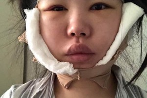 鄭大一附院有整形科怎么樣？下頜角術(shù)真實(shí)案例|醫(yī)生推薦