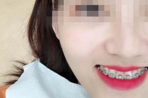 青島優(yōu)諾博士口腔醫(yī)院牙齒矯正怎么樣？恢復(fù)圖分享