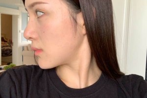 廈門第一醫(yī)院美容科下頜角怎么樣？術(shù)前術(shù)后對比圖！