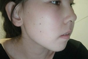 協(xié)和醫(yī)院整形科硅膠隆鼻價位？真實案例分享！