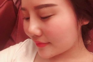 深圳北大醫(yī)院美容科膨體隆鼻好嗎？真實案例分享！