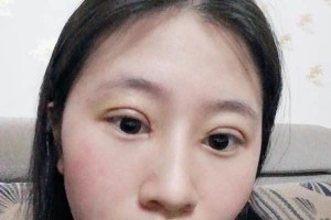 南昌大學(xué)美容醫(yī)院切開雙眼皮是正規(guī)嗎？附果圖&價(jià)格表