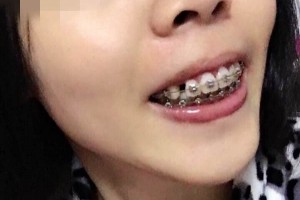 北京億大口腔醫(yī)院牙齒矯正怎么樣？附較新價格表！