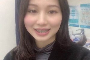 濟(jì)南圣貝口腔醫(yī)院牙齒矯正怎么樣/真實(shí)案例對(duì)比！