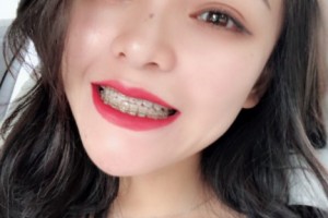 重慶美奧口腔醫(yī)院怎么樣？附醫(yī)院信息+正畸果圖