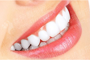 西安做美容冠醫(yī)院排行榜醫(yī)院實力簡介|美容冠項目術(shù)后案例評價_醫(yī)院優(yōu)勢